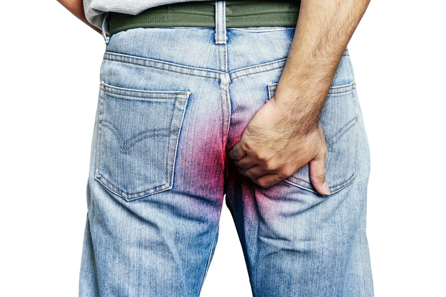 Drenaje de absceso anorrectal